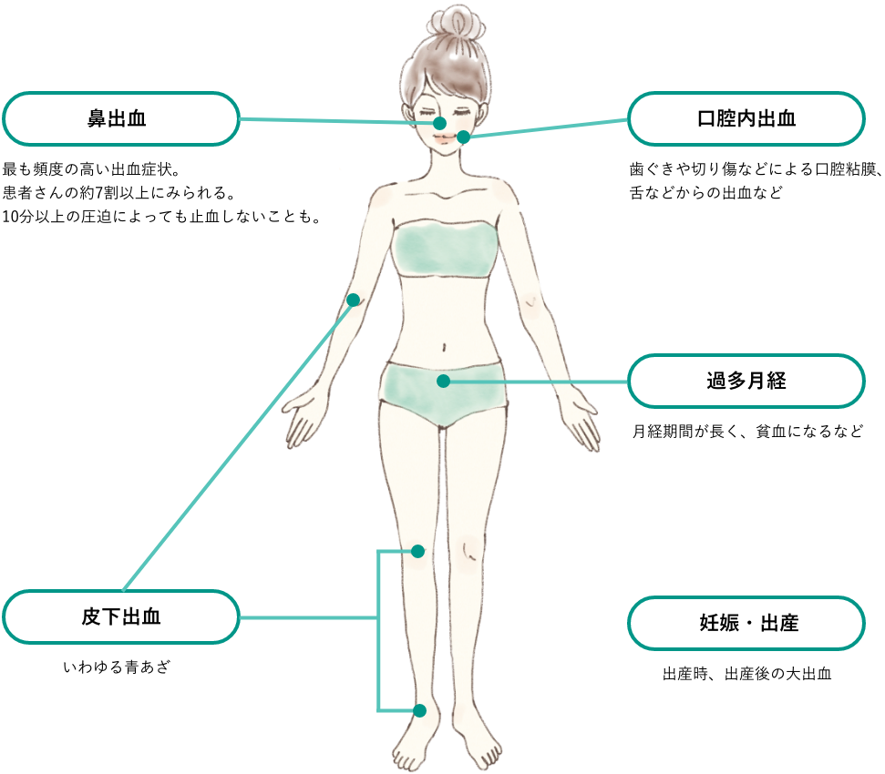 主な出血症状と特徴